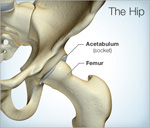 acetabular fracture surgery kolkata