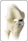 acetabular fracture surgery kolkata