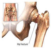 pelvic fracture surgery kolkata