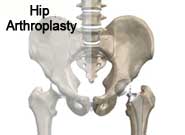 acetabular fracture surgery kolkata