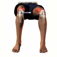 custom fit knee surgery kolkata