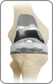 custom fit knee surgery kolkata
