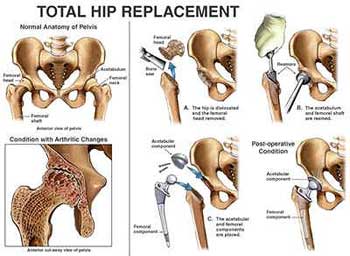 replacement surgery in kolkata